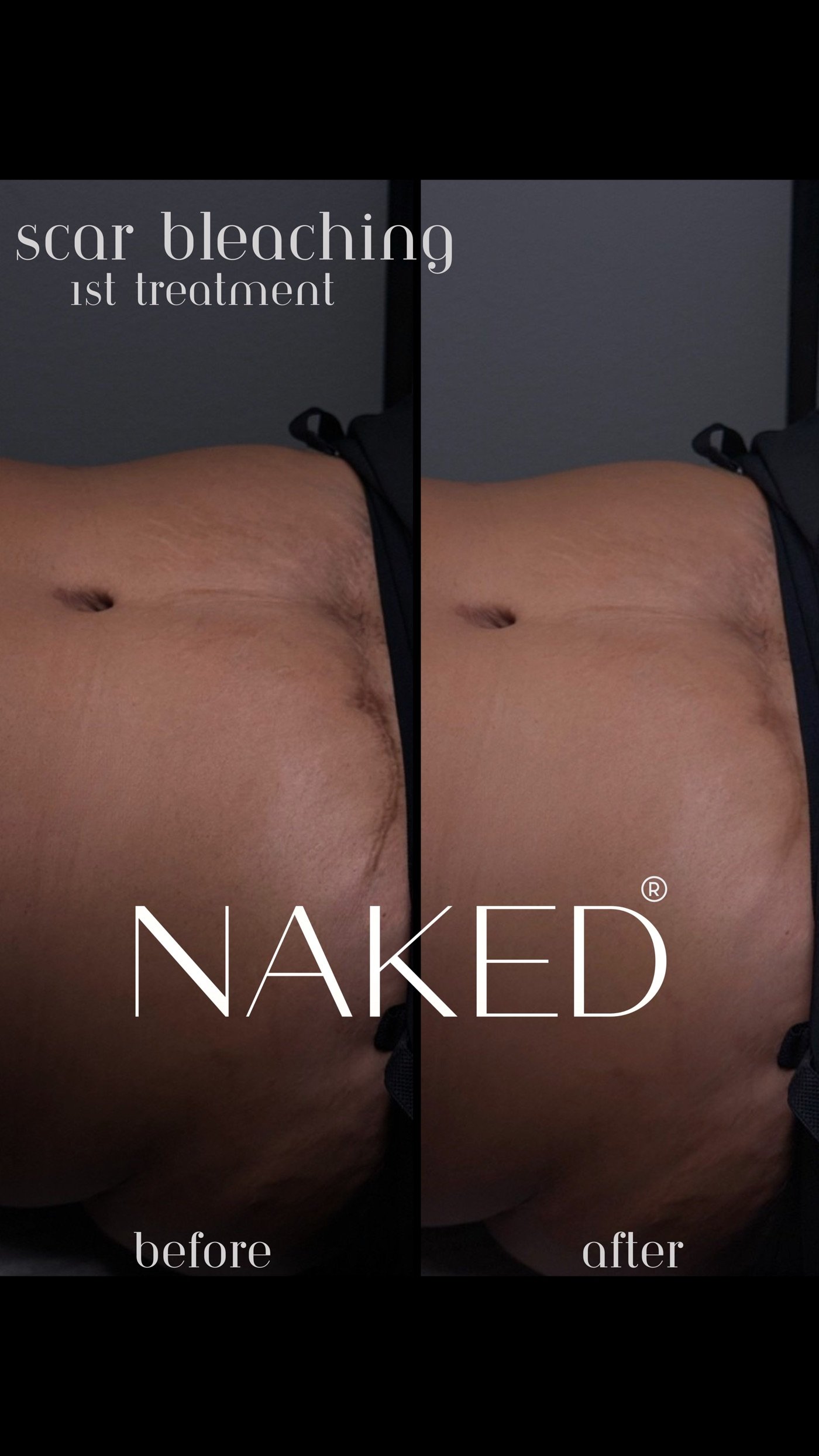 Scar brightening before and after, first treatment